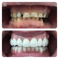 Fațete Dentare ( Veneers)